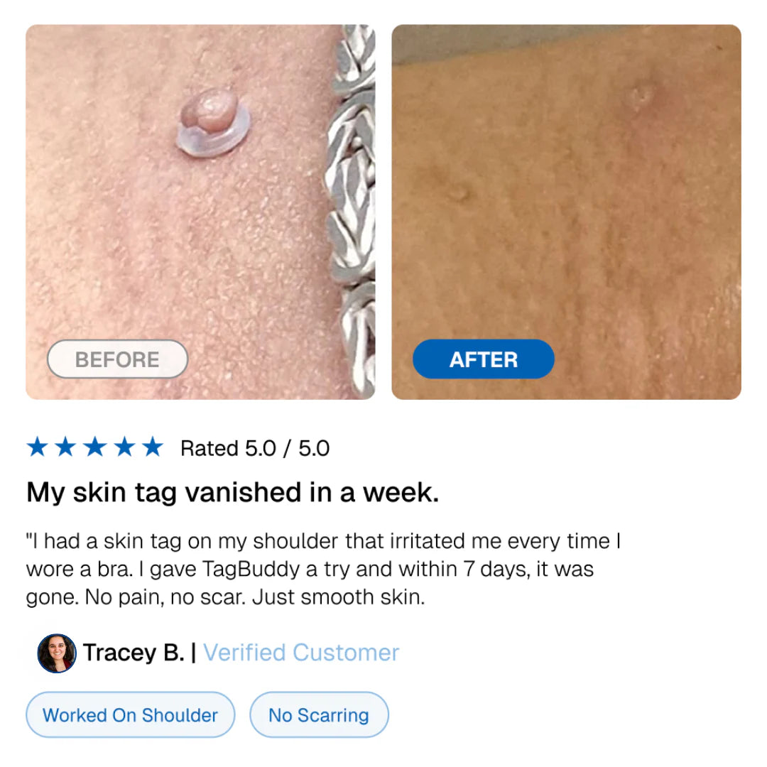 LunaSmooth™ Skin Tag Removal Kit